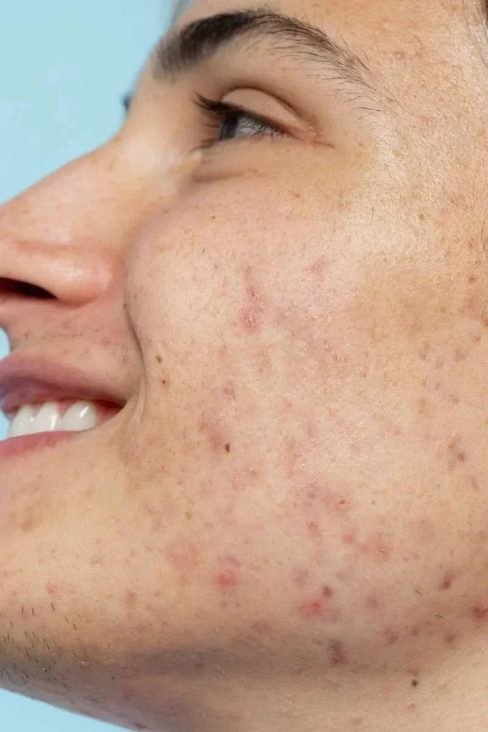 acné peau visage huile ozonée soin pozone