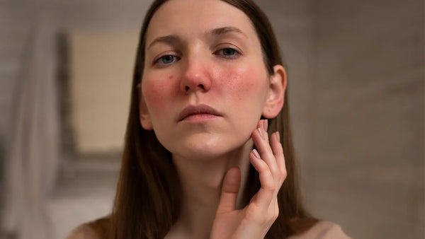 peau sensible femme rosacee huile ozonée soin pozone