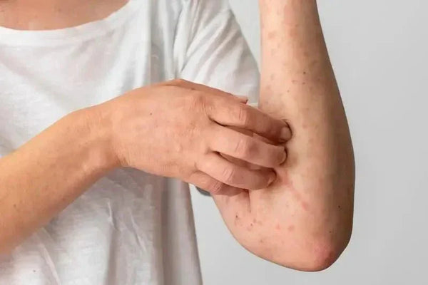 eczéma peau huile ozonée soin pozone