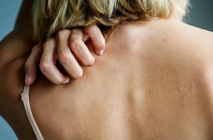 stress peau atopique démangeaisons soin huile ozonée pozone