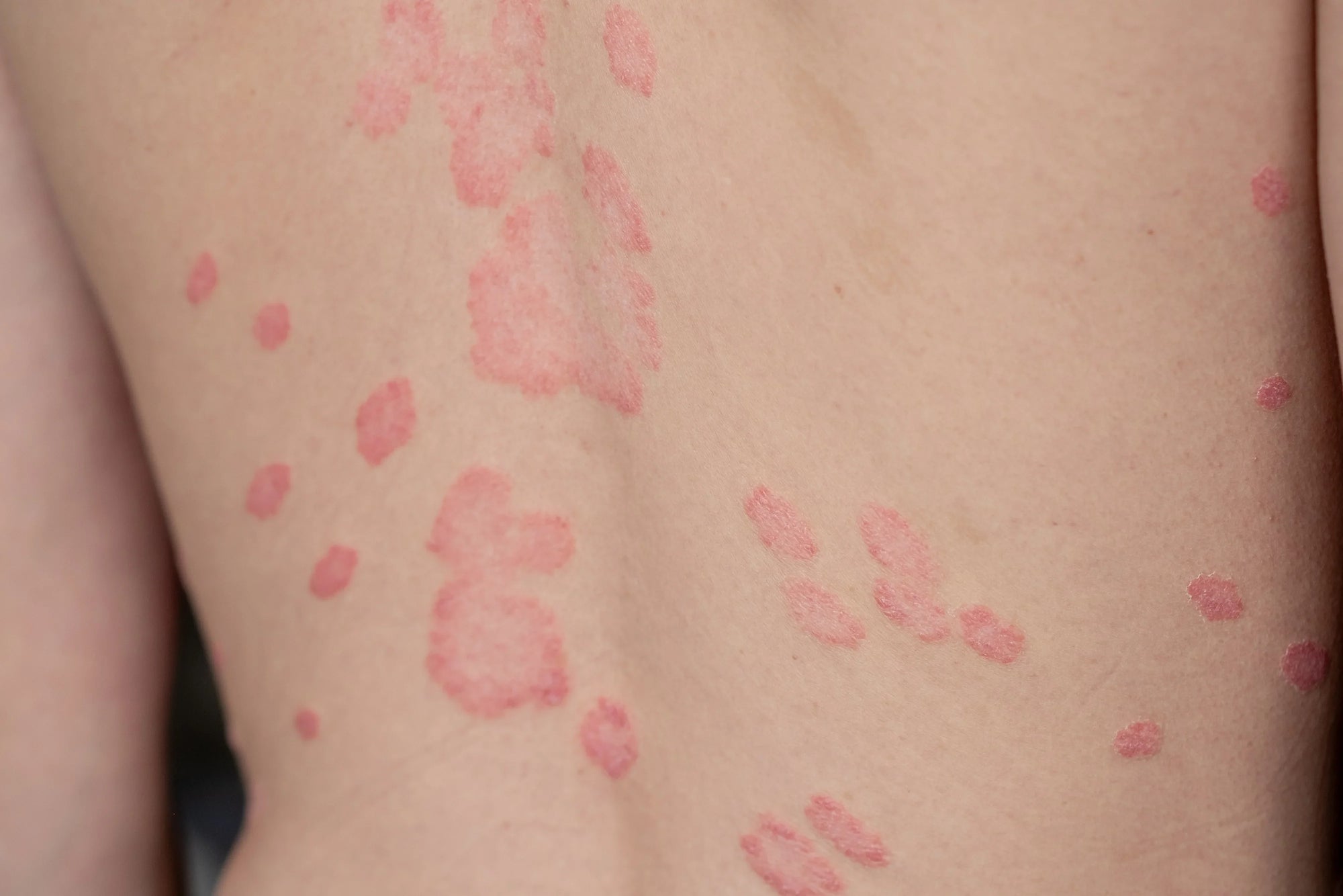 L'huile ozonée & Psoriasis - Pozone